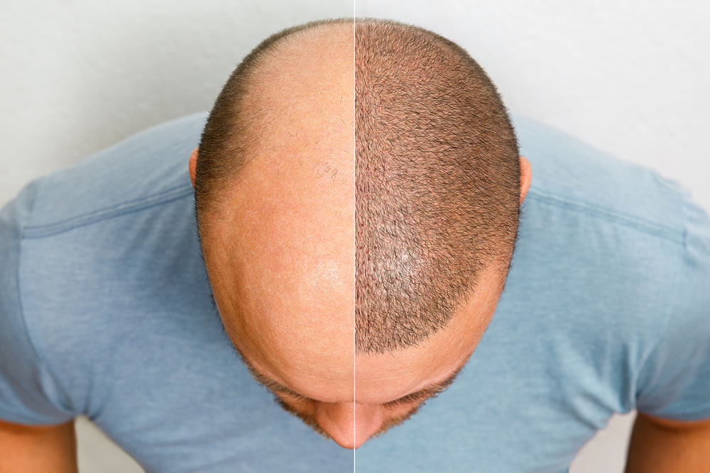 balding man before and after